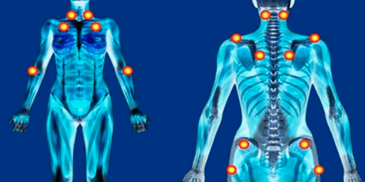 Fibromialgia: cannabis pode reduzir até 30% da dor