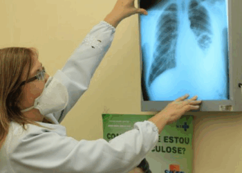 Governo Federal cria comitê para eliminar a tuberculose