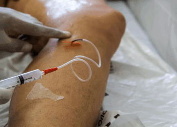 A cada dia, 145 mulheres são internadas para tratar varizes