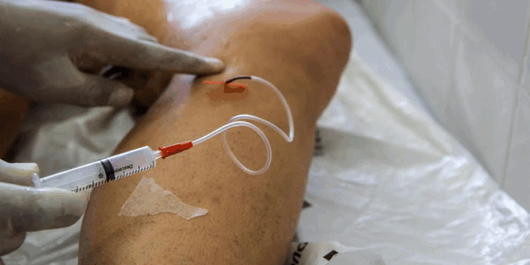 A cada dia, 145 mulheres são internadas para tratar varizes