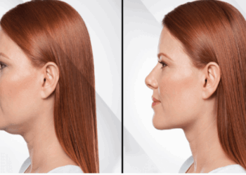 Lipo de papada: saiba quais são os riscos e limitações do procedimento