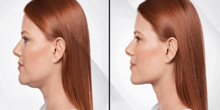 Lipo de papada: saiba quais são os riscos e limitações do procedimento