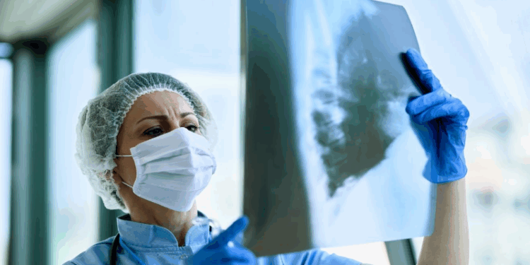 85% dos casos de câncer de pulmão podem ser evitados; entenda