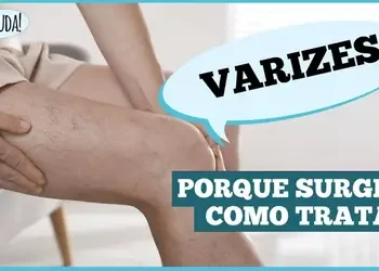 Varizes: não é só estética é saúde vascular