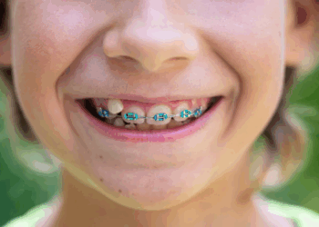 Extração de dentes ao usar aparelho: necessidade ou alternativa?