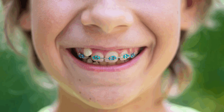 Extração de dentes ao usar aparelho: necessidade ou alternativa?