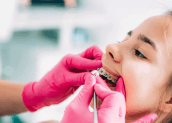 Aparelho ortodôntico na infância: saiba a idade ideal e os cuidados