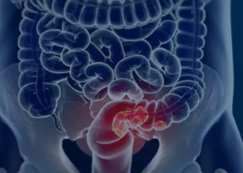 Pacientes com câncer colorretal são diagnosticados em estágio avançado