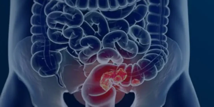 Pacientes com câncer colorretal são diagnosticados em estágio avançado