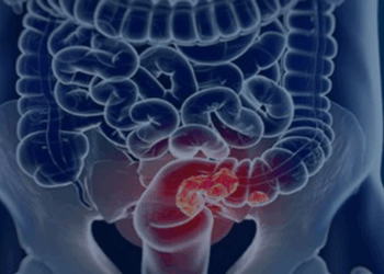 Estudo projeta aumento de 36% em mortes por câncer colorretal até 2040