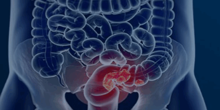 Estudo projeta aumento de 36% em mortes por câncer colorretal até 2040